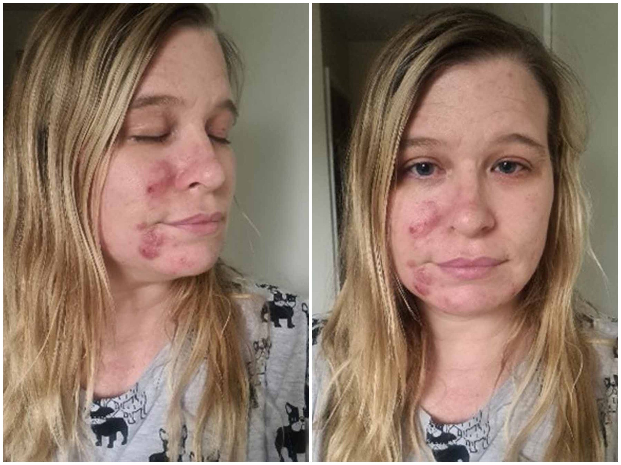 woman-hails-85-skincare-kit-as-miracle-cure-for-her-cystic-acne